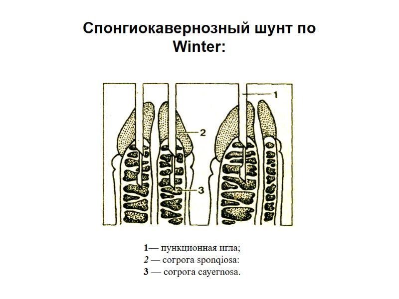 Спонгиокавернозный шунт по Winter: 1— пункционная игла;  2 — согрога sponqiosa:  3